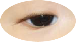 先天性眼瞼下垂